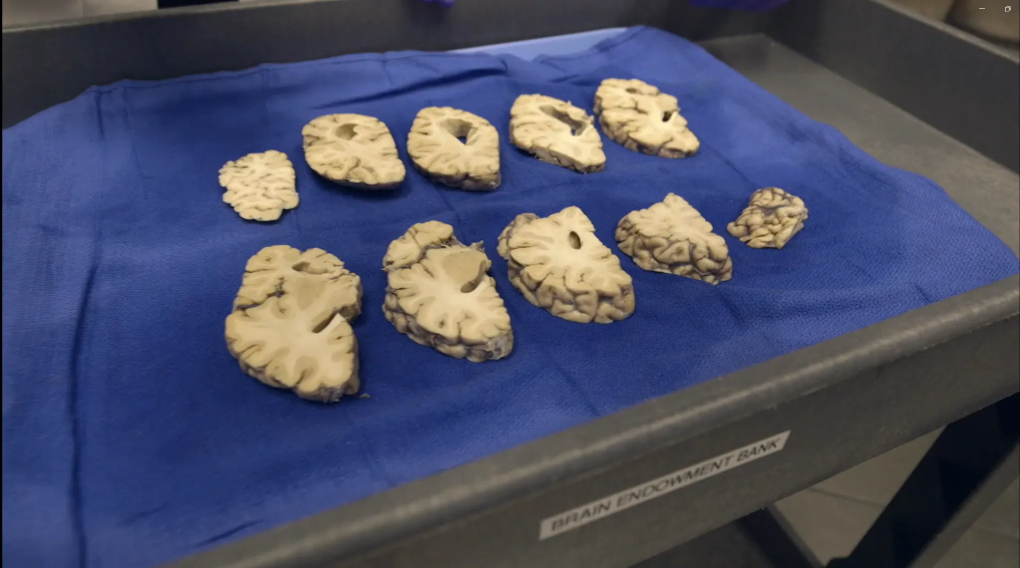 Brain tissue samples examined in the report